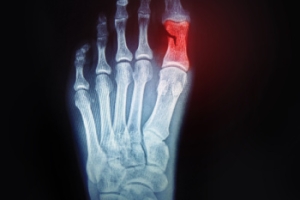How Toe Fractures Are Identified and Treated