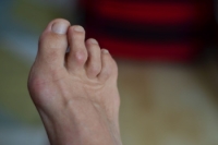 Most Hammertoes Start With Muscle Imbalance
