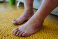 The Importance of Diabetic Foot Care