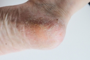 When Cracked Heels Are Beyond Unsightly