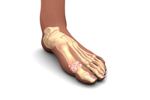 Gout in Children Is a Rare but Painful Condition