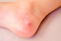 Understanding Diabetic Blisters on the Feet