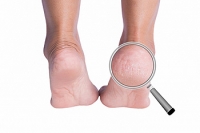 Treatment for Cracked Heels