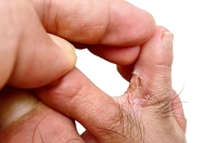 Athlete's Foot and Its Potential to Spread